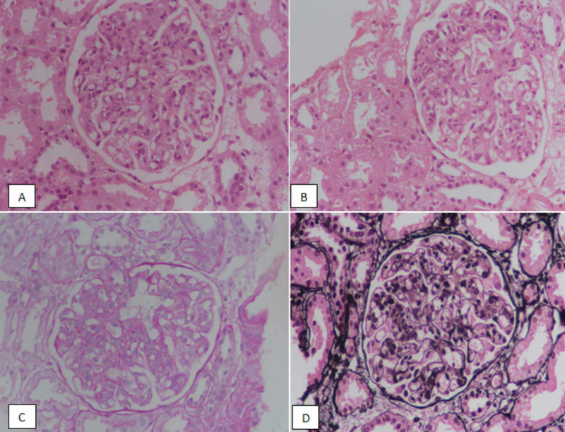 <p>Lupus Nephritis, Class IV