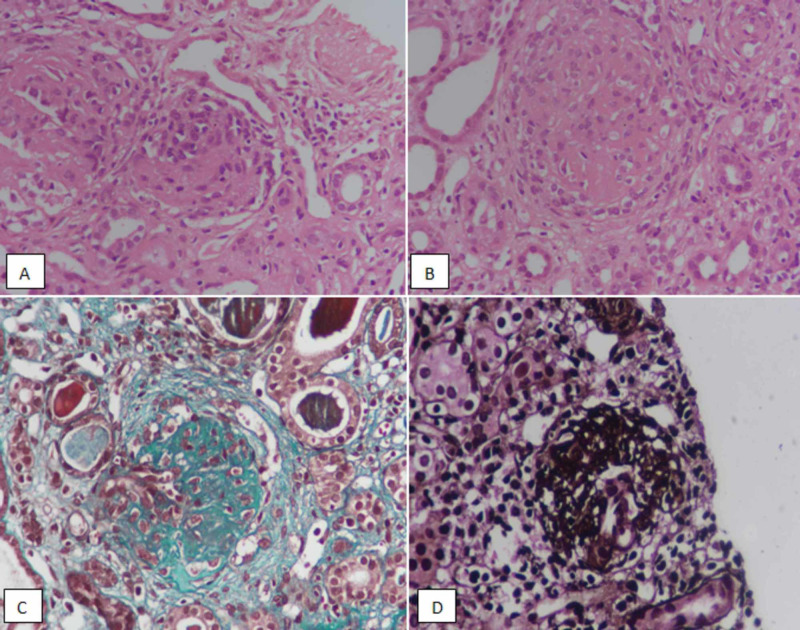 <p>Lupus Nephritis, Class III