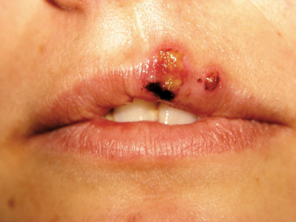 Herpes Simplex