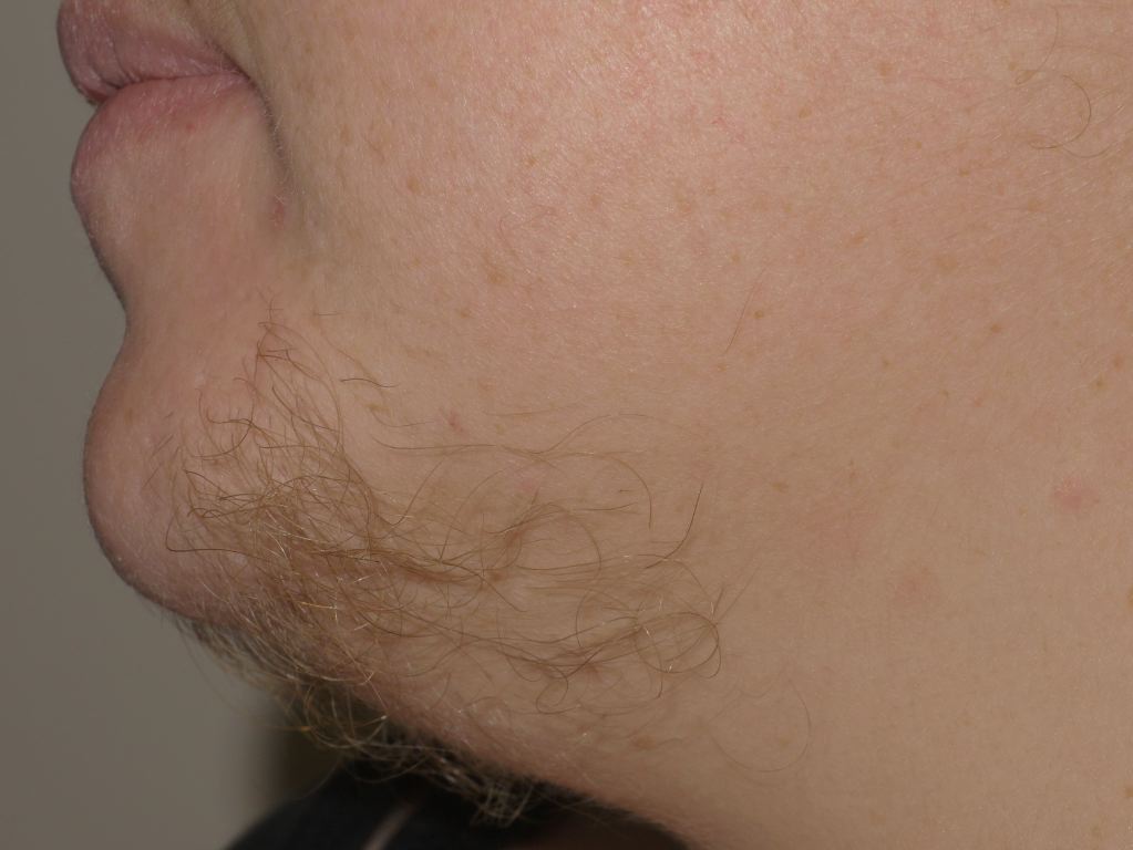 Hirsutism, Chin