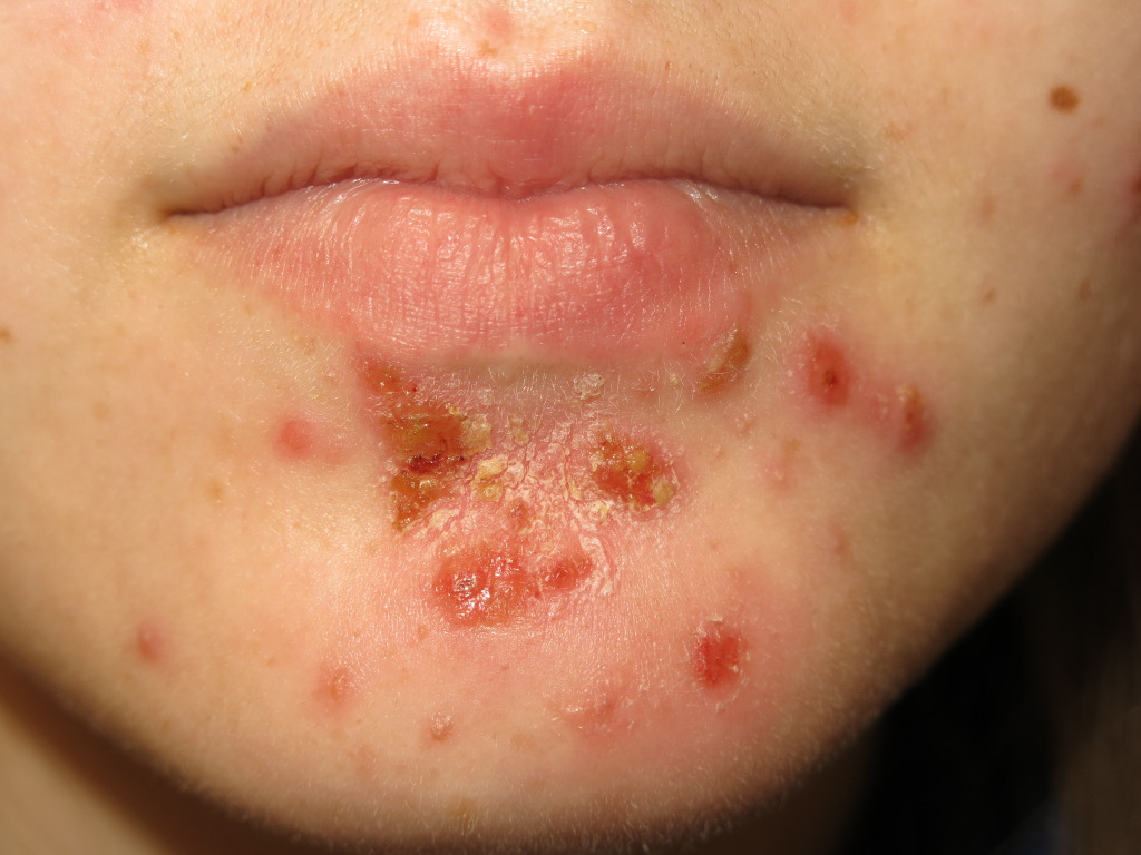 Impetigo, Skin Infection