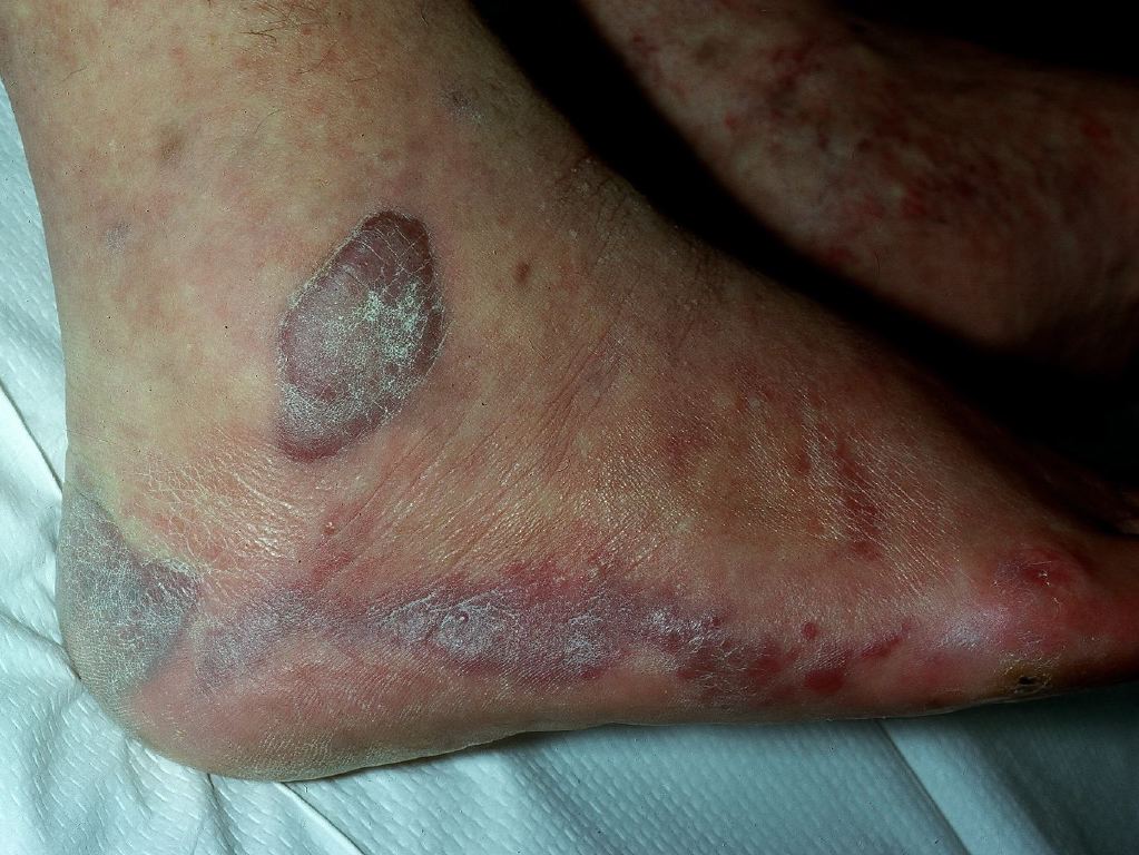 Kaposi Sarcoma