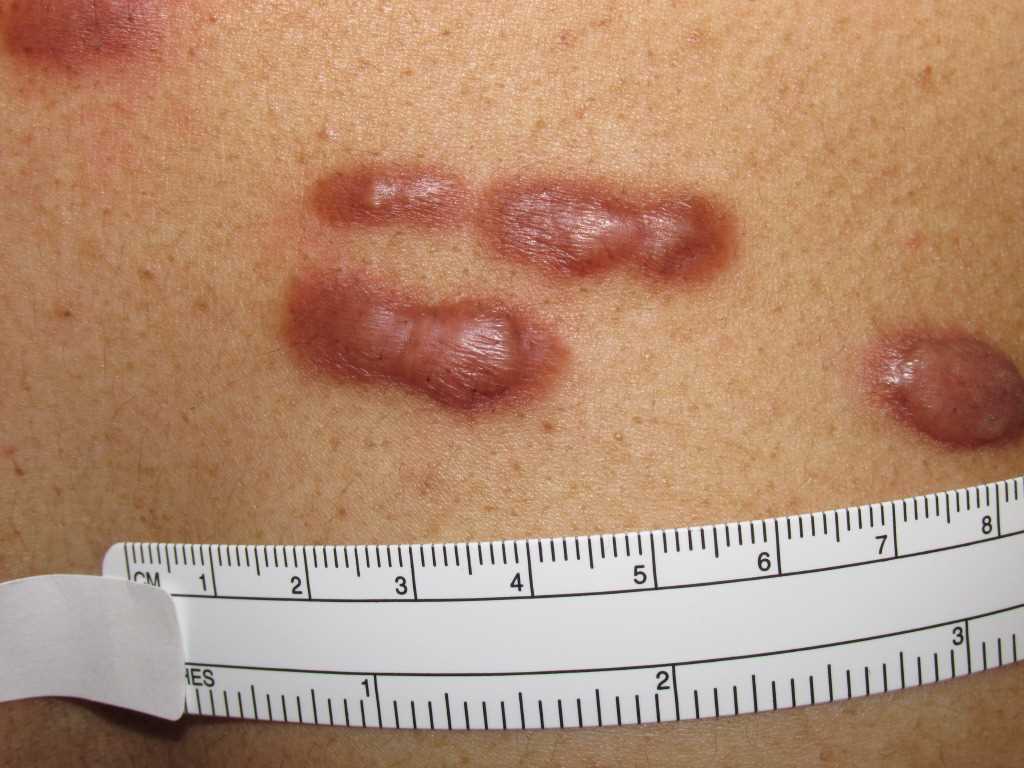 Keloid Scars