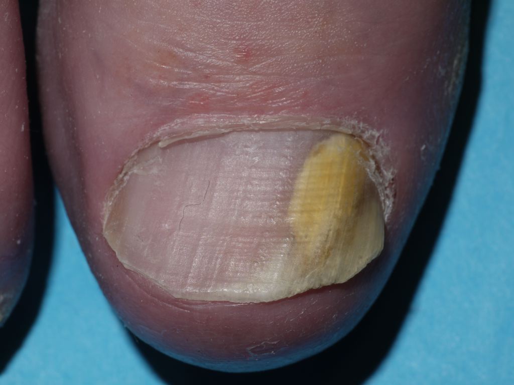 Lateral Onychomycosis