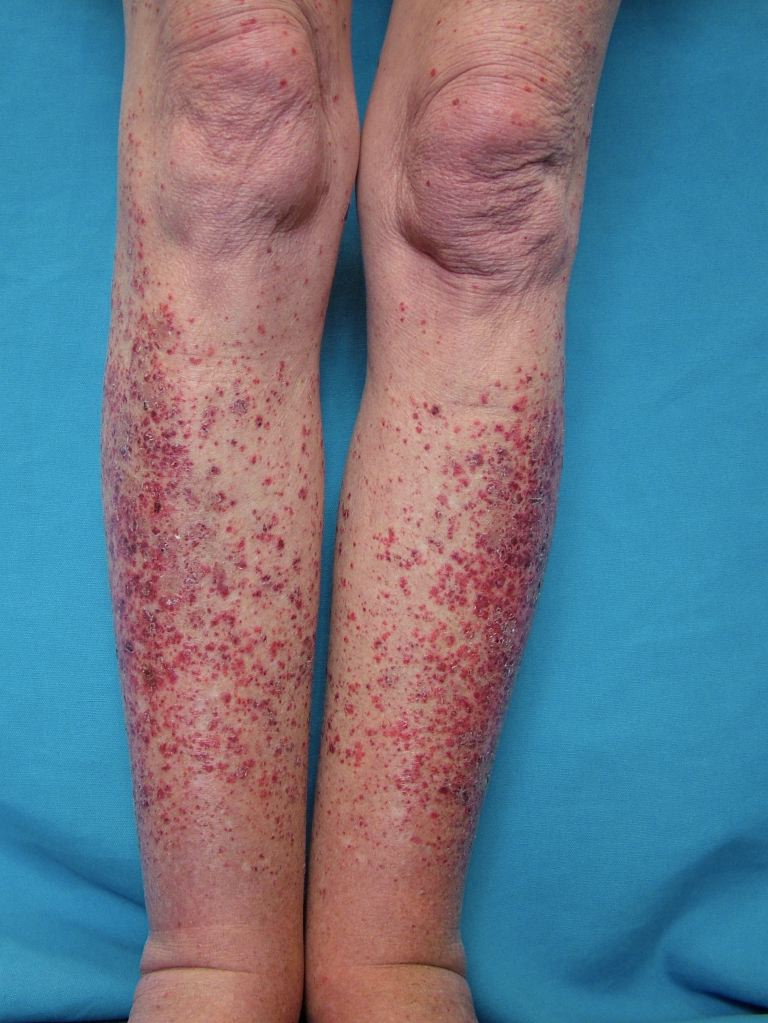 Leukocytoclastic Vasculitis