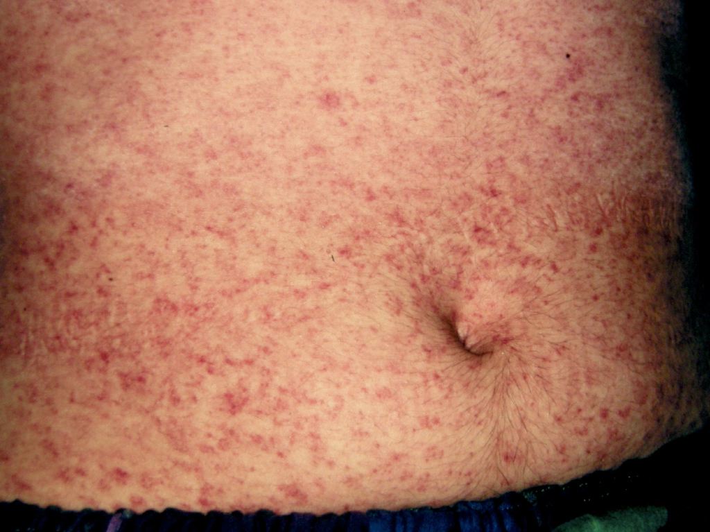 Measles Infection