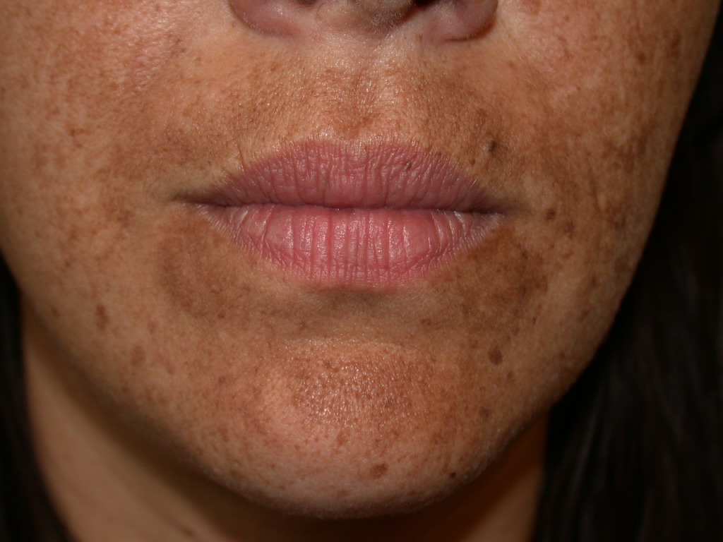 Melasma, Face