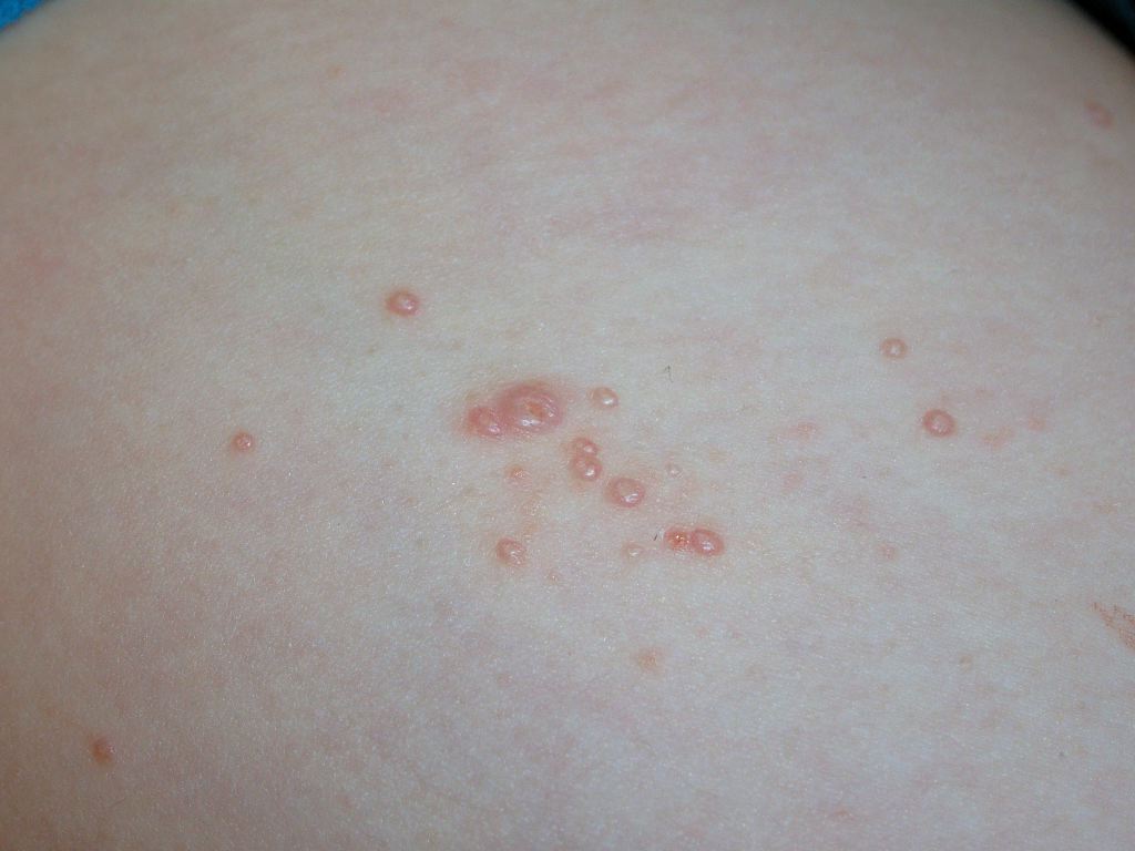 Molluscum Contagiosum