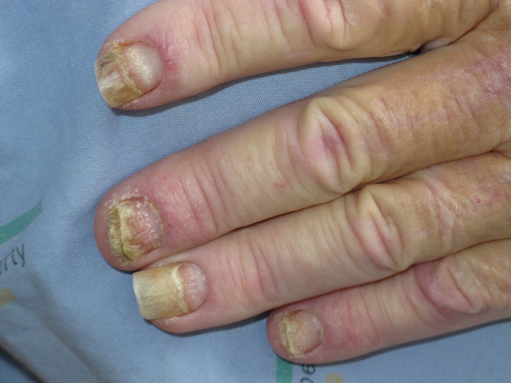 Nail Psoriasis