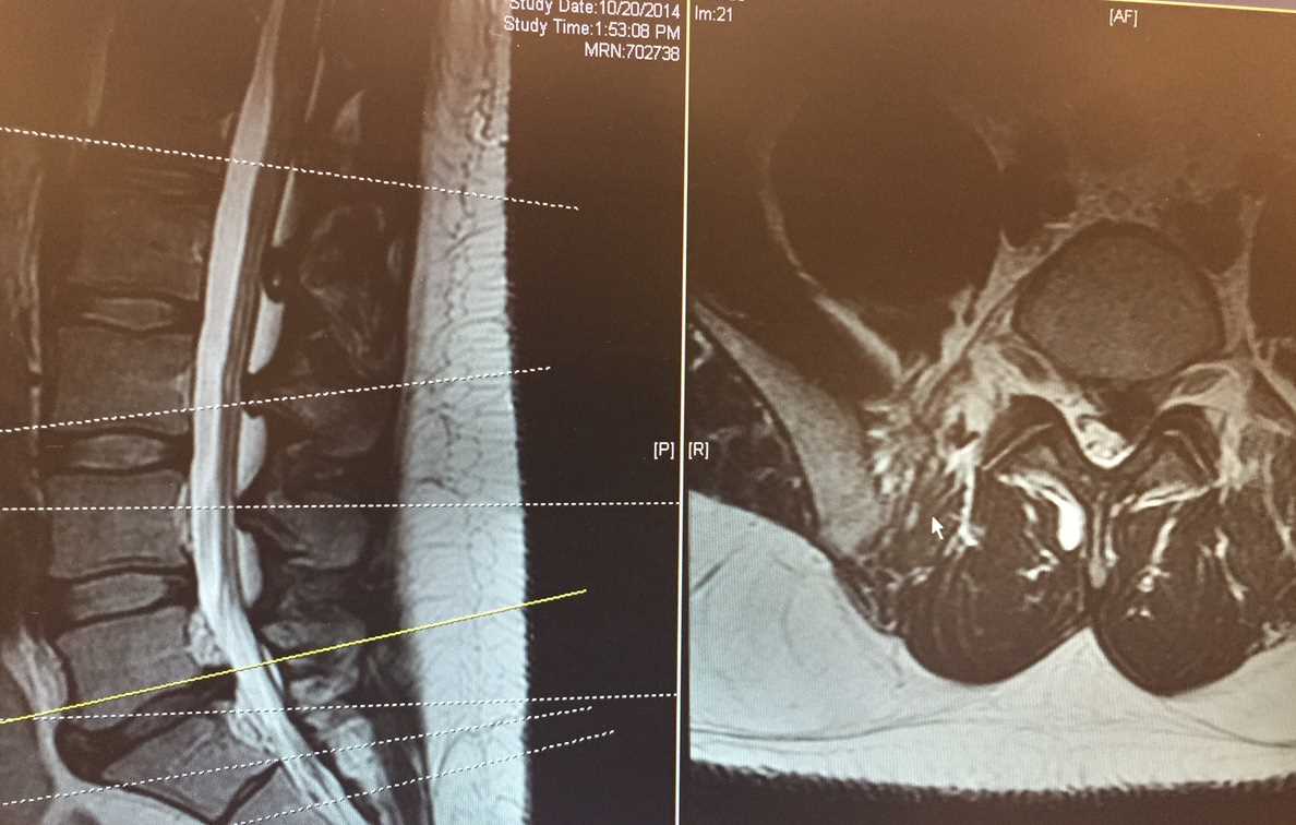 Lumbar MRI T2 Sagital and Axial Slice