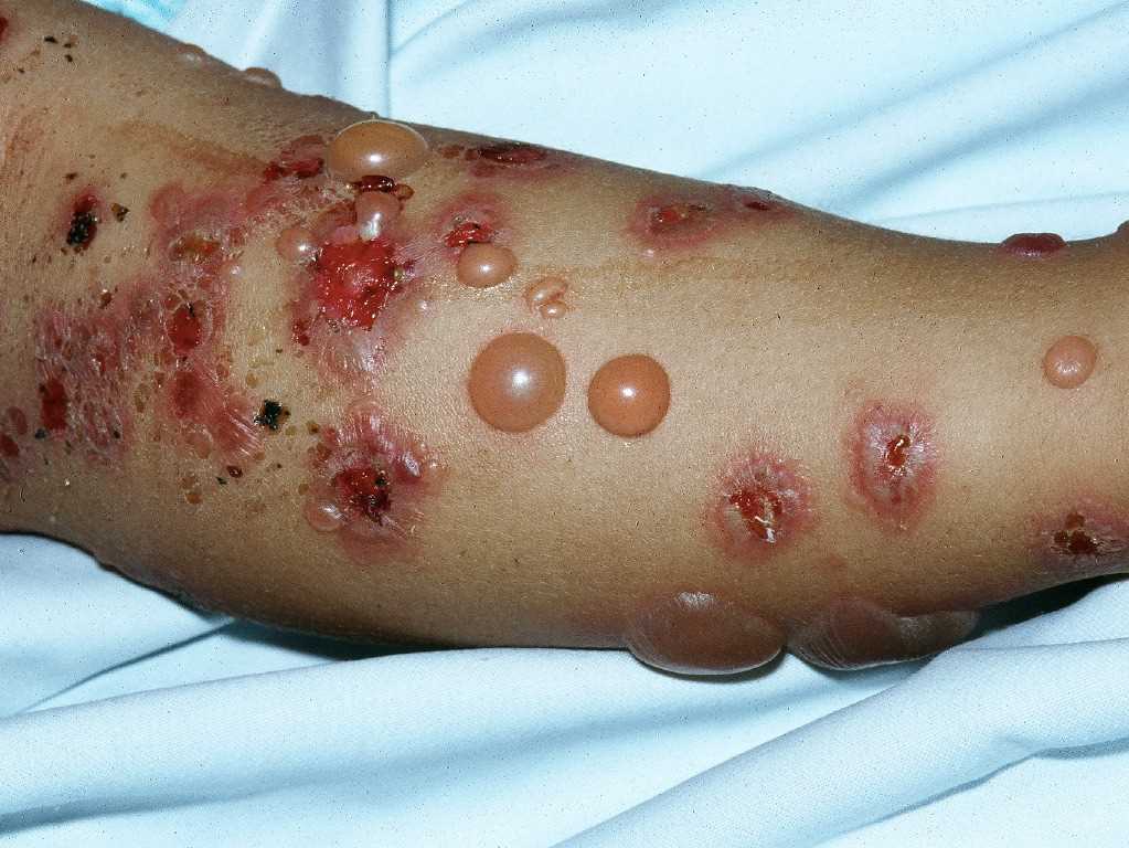 Pemphigoid