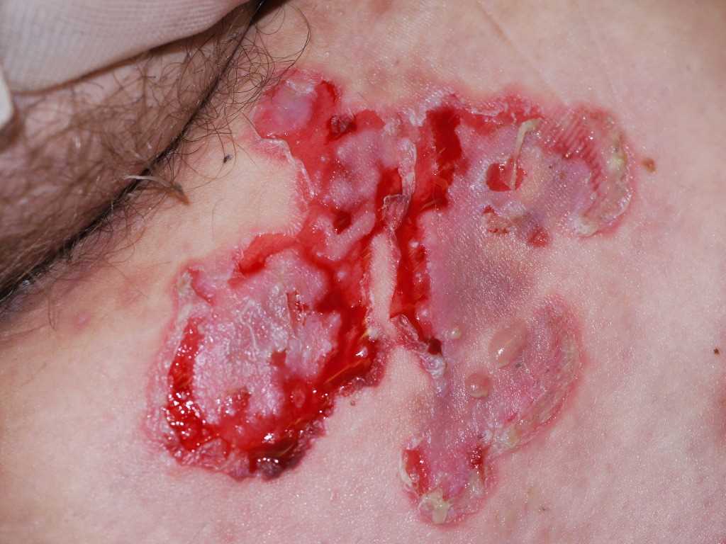 Pemphigus Vulgaris