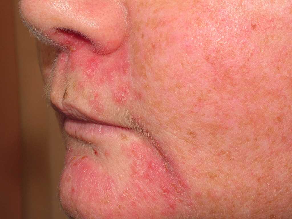 <p>Perioral Dermatitis</p>