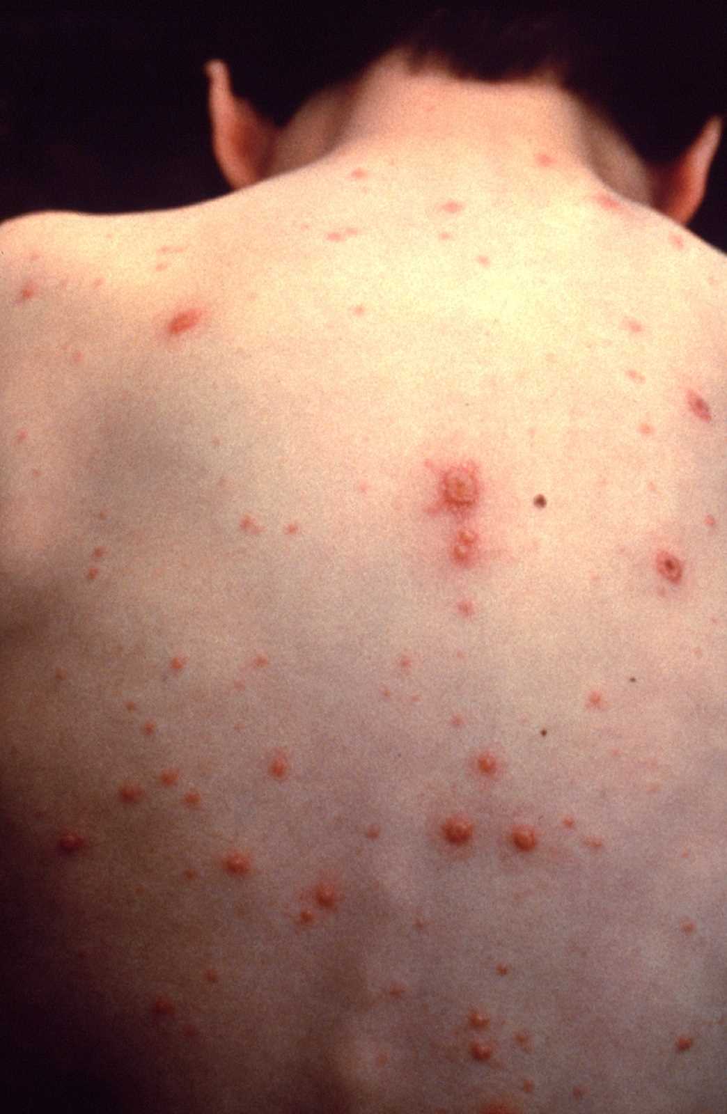 Chickenpox (Varicella). Chickenpox in an unvaccinated child.