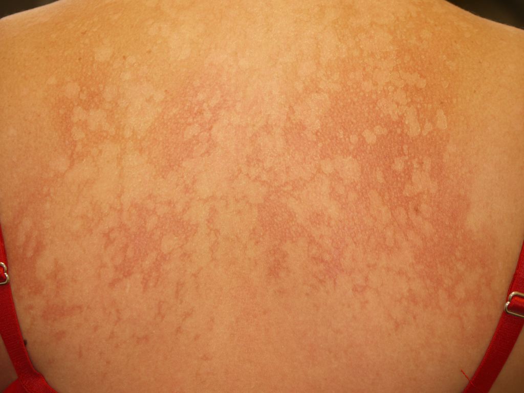 Pityriasis Versicolor