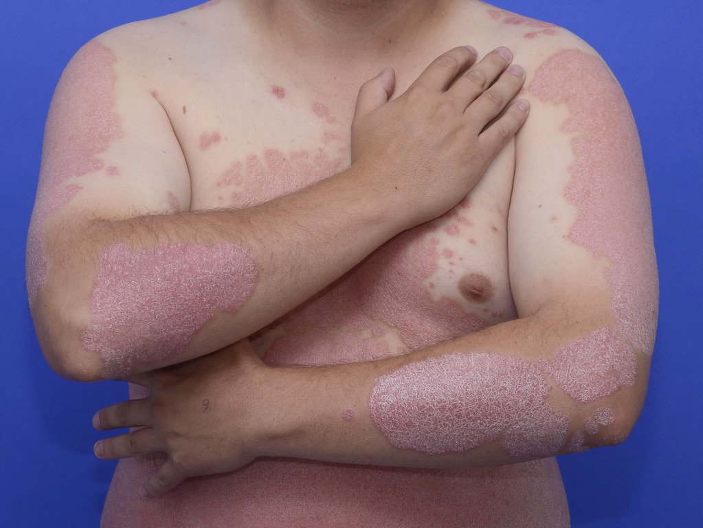 Plaque Psoriasis