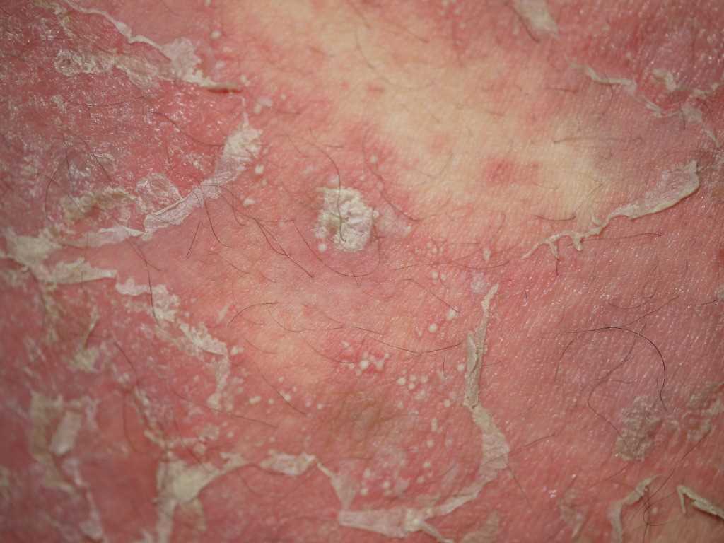 Pustular Psoriasis