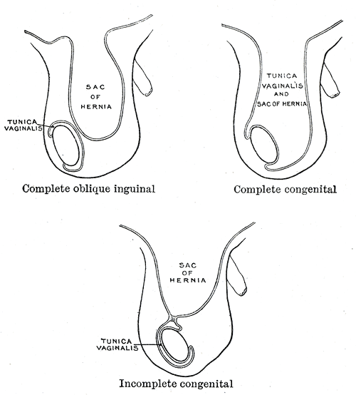 The Large Intestine, Varieties of oblique inguinal hernia, Complete oblique inguinal hernia, Sac of Hernia, Tunica vaginalis 