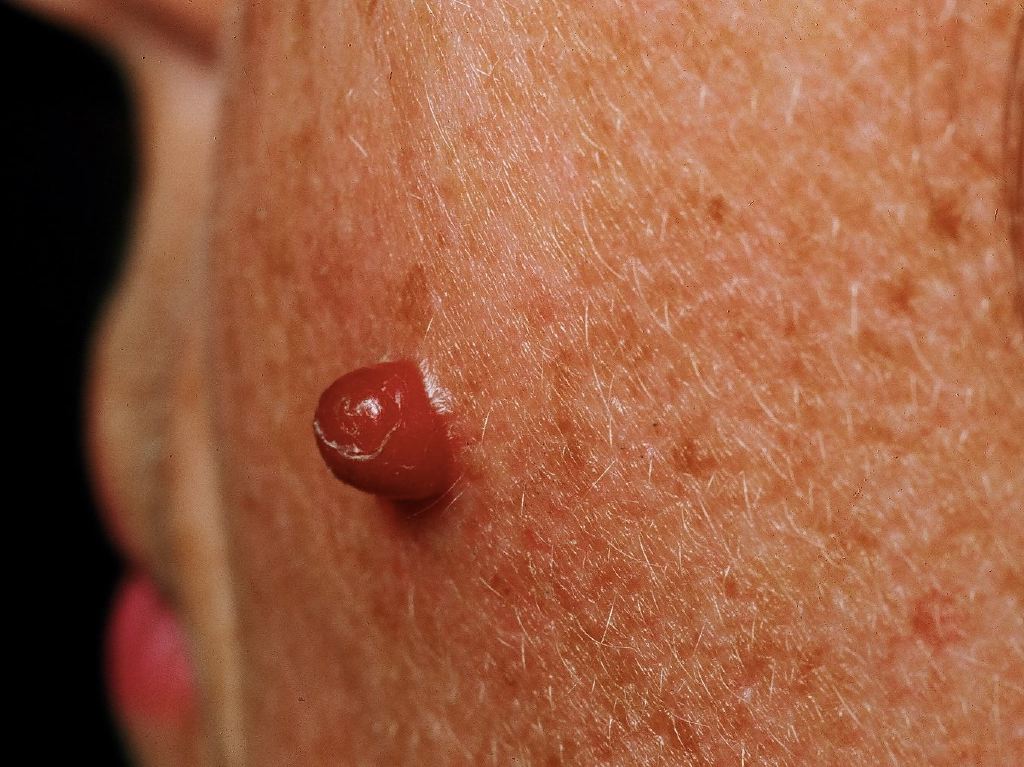 Pyogenic Granuloma