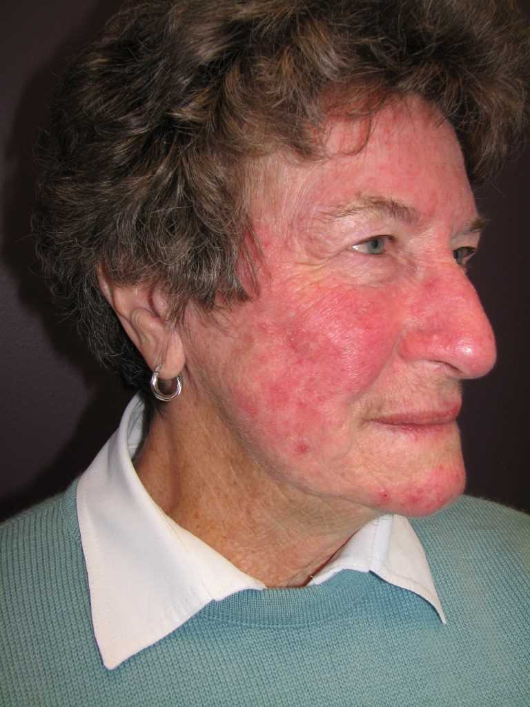 Rosacea, Face