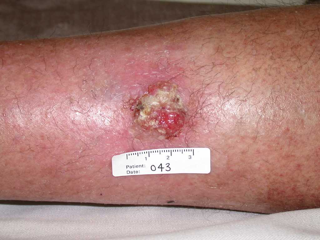 Squamous Cell Carcinoma