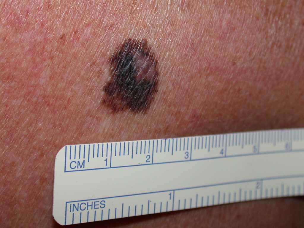 Superficial Melanoma