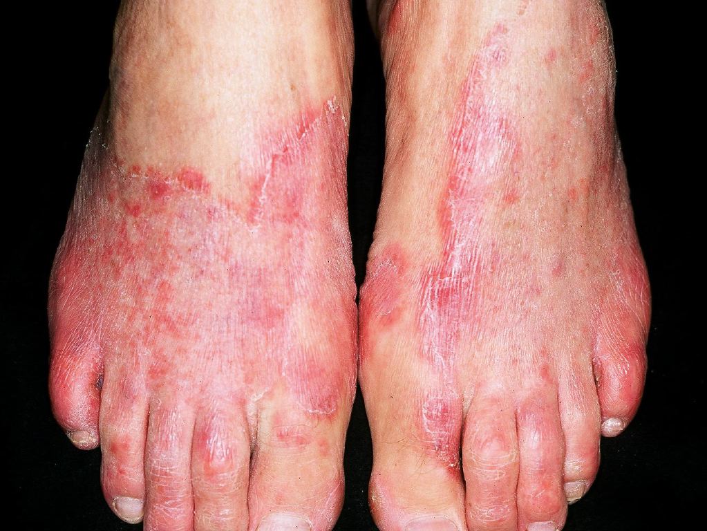 Tinea Pedis