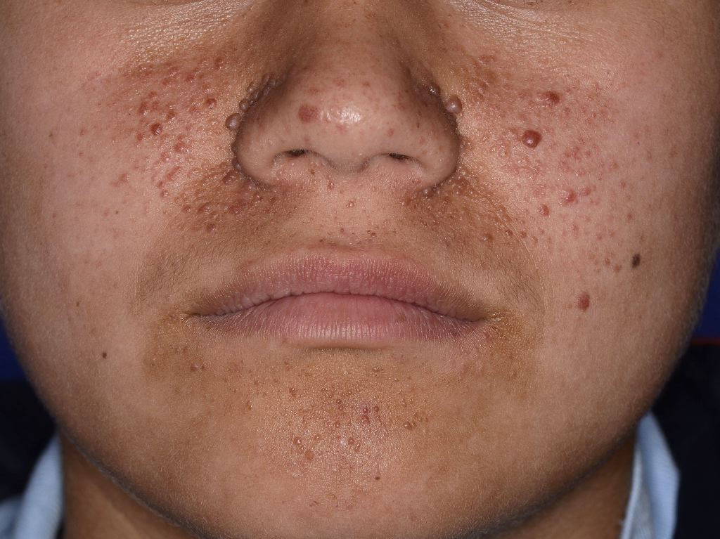 Tuberous Sclerosis Angiofibromas