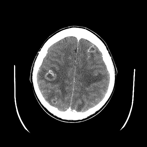 Axial CT Brain With Contrast Abscesses