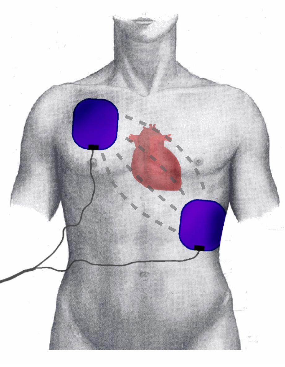 <p>Defibrillation Pad Positioning