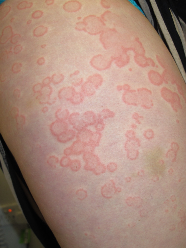 Urticaria, Upper Arm