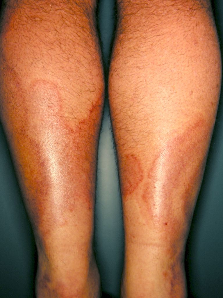 Urticarial Vasculitis