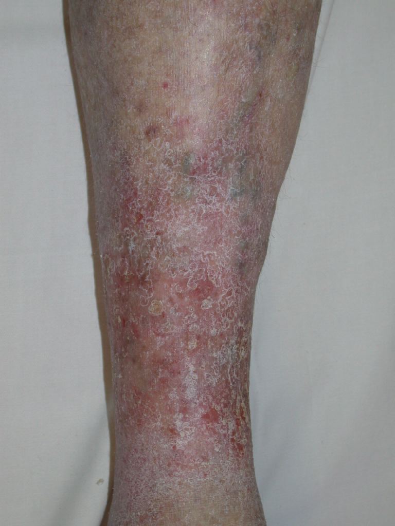 Venous Eczema