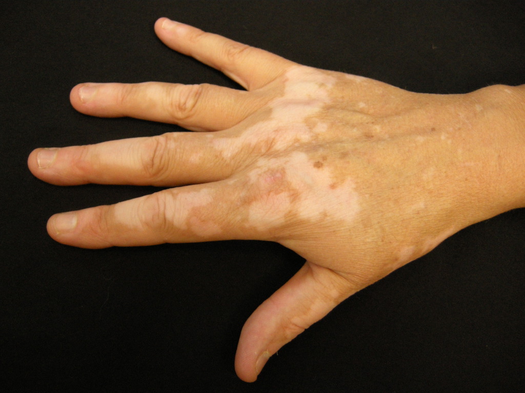 Vitiligo, Hand