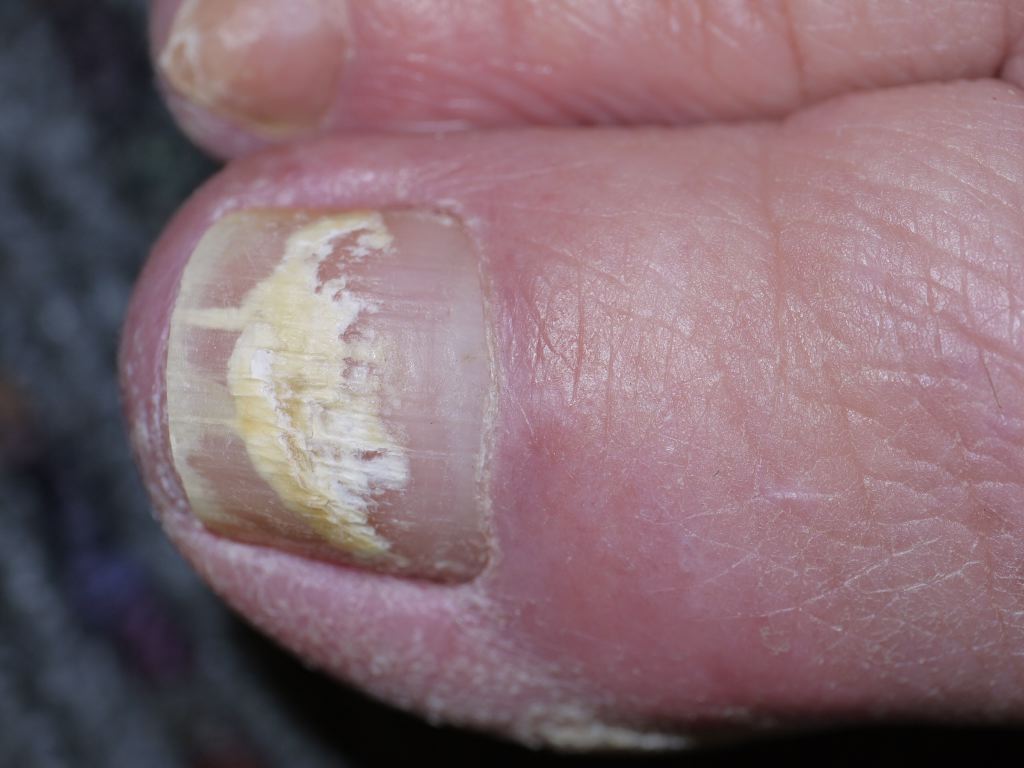 White Superficial Onychomycosis