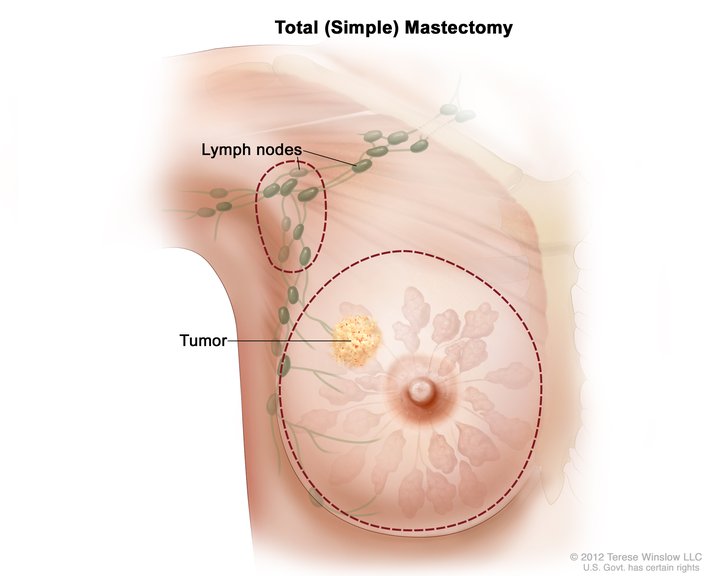 Total (simple) mastectomy; drawing shows removal of the breast and lymph nodes