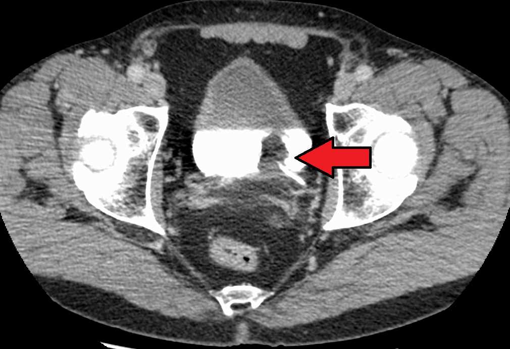 Transitional cell carcinoma of the bladder. The white in the bladder is contrast.