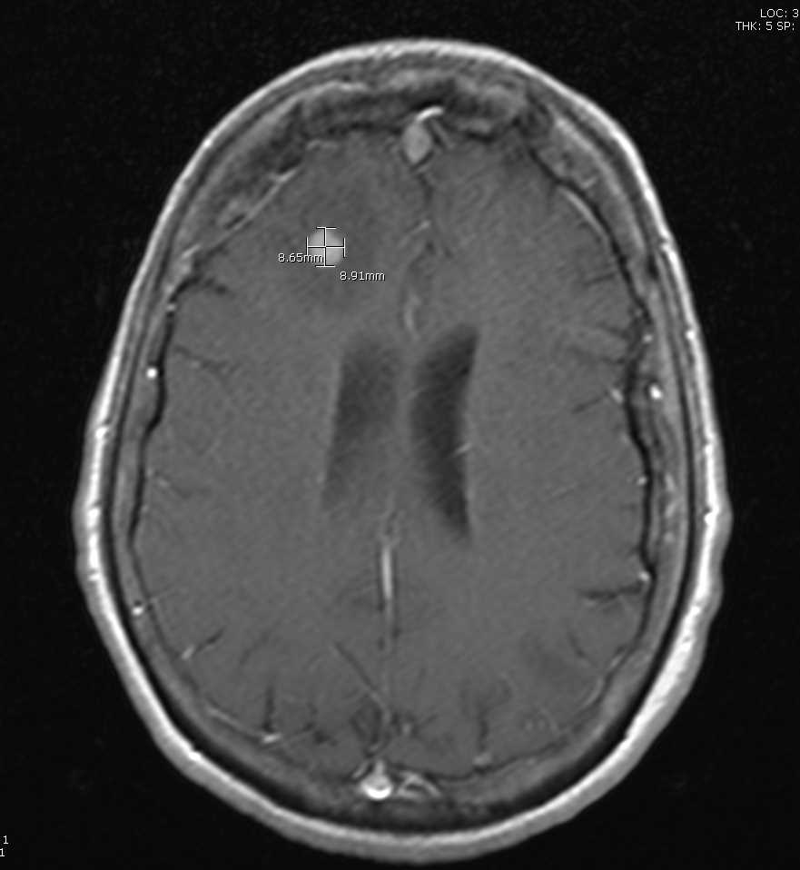 T1-Weighted Postcontrast MRI Image Showing Lung Cancer