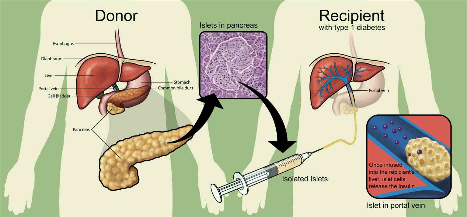 The process of clinical islet transplantation for the treatment of diabetes