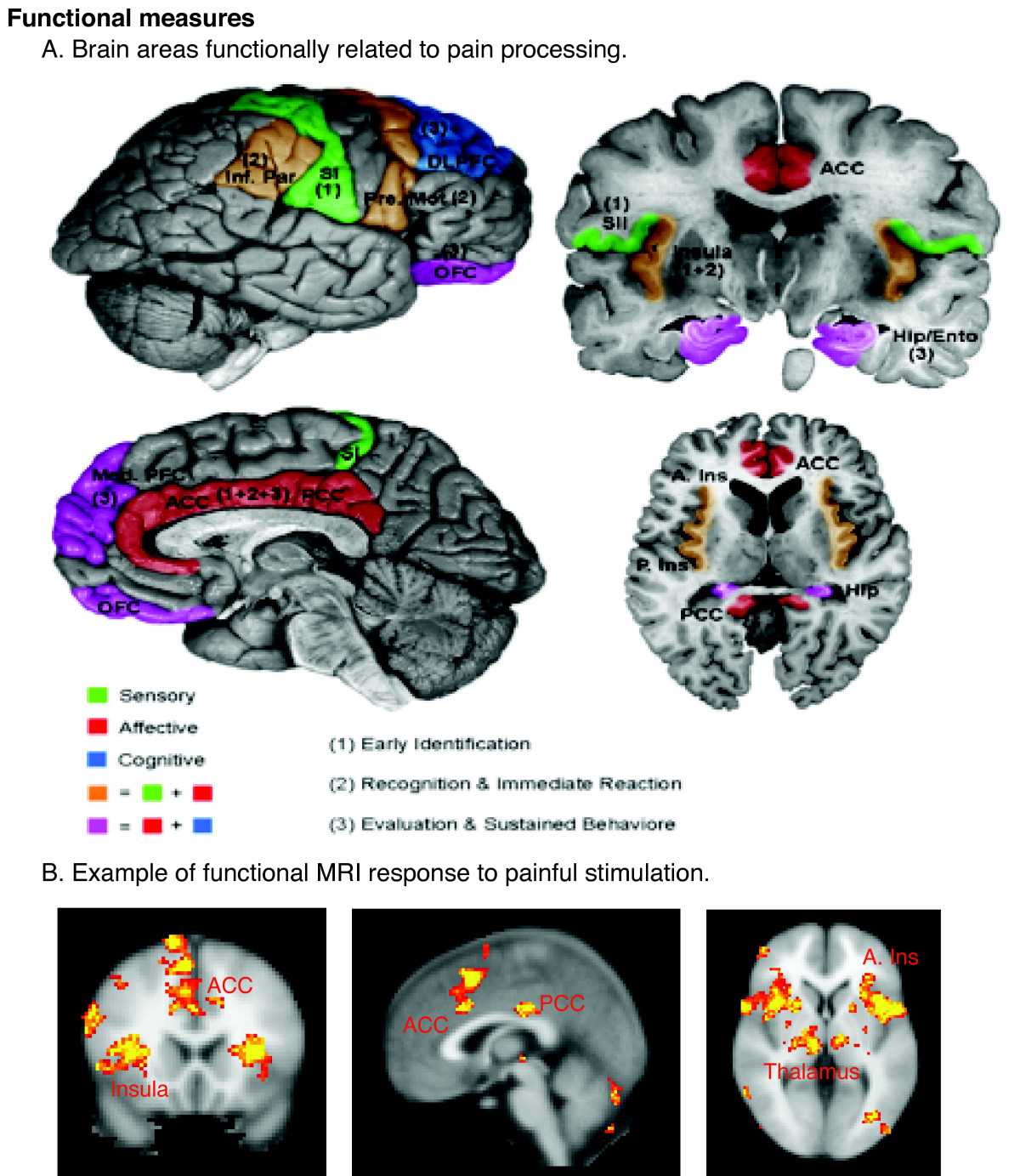 Regions of the cerebral cortex associated with pain.
Neuroimaging revolutionizes therapeutic approaches to chronic pain