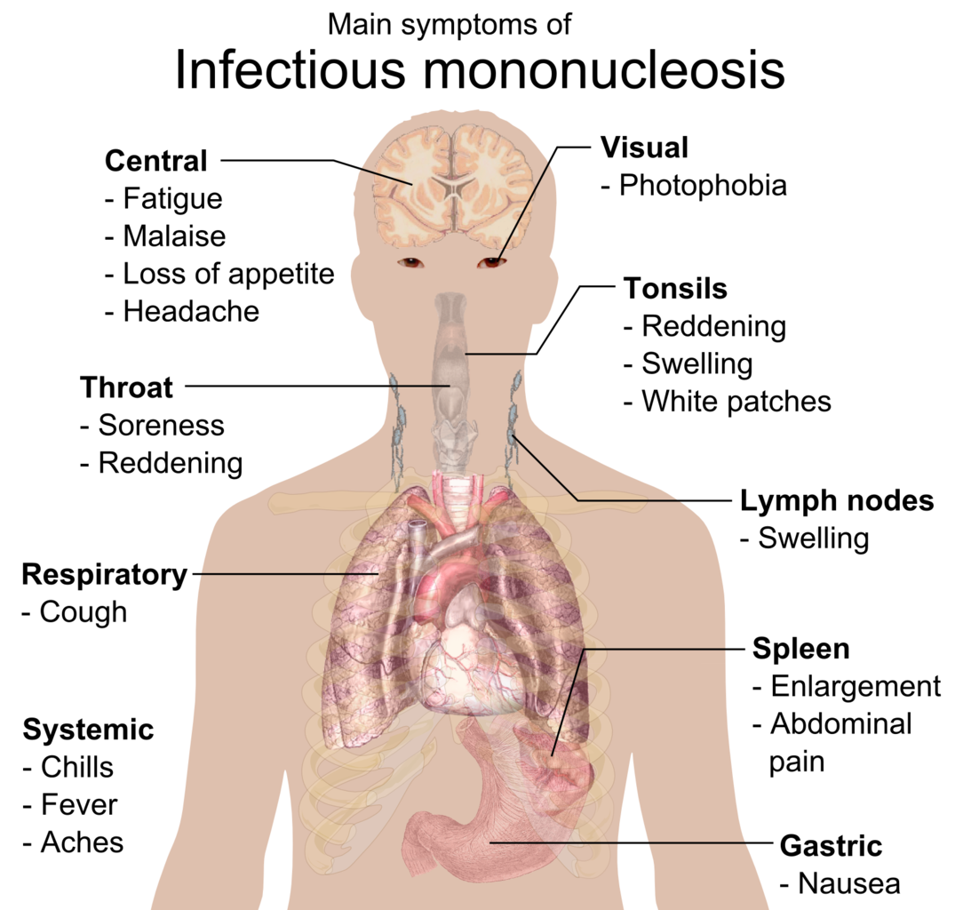 Main symptoms of infectious mononucleosis