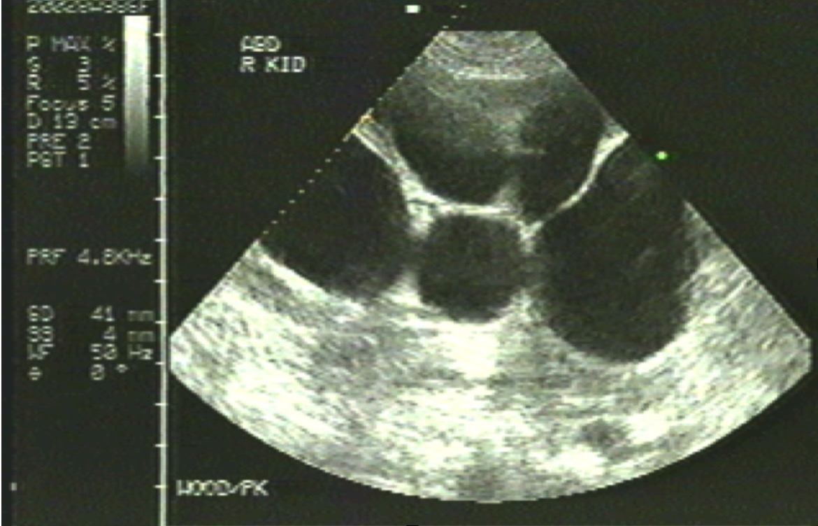 Polycystic Kidney