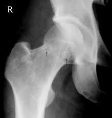 Dysbaric Osteonecrosis of the hip