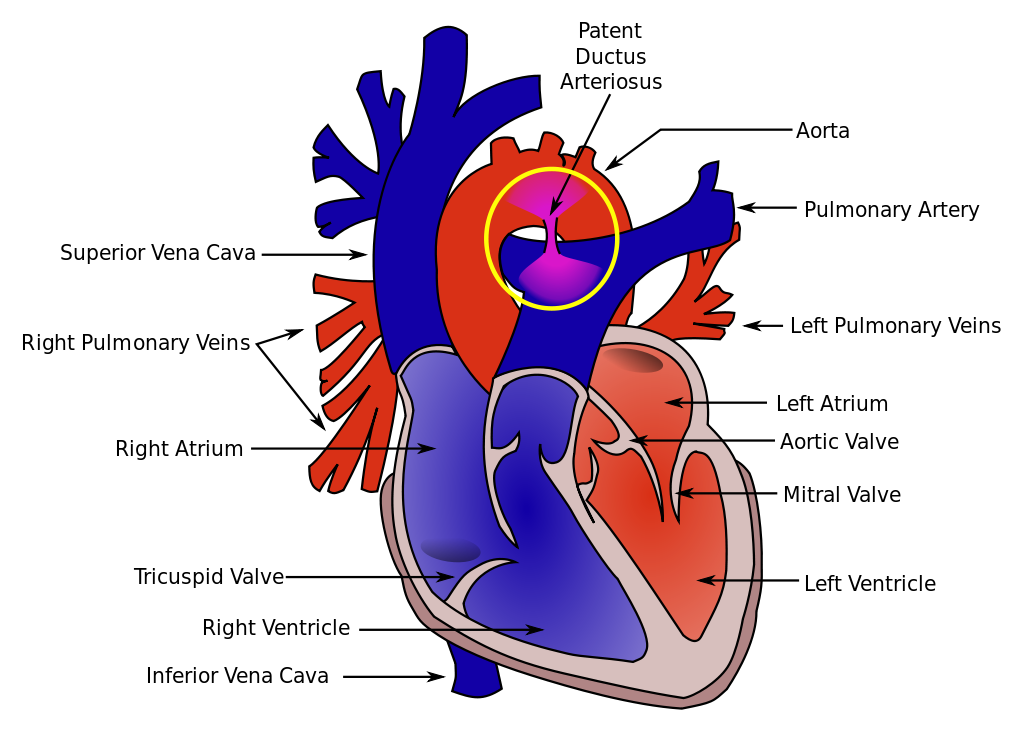 Heart cross section with Patent Ductus Arteriosus