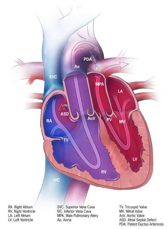 dextro-Transposition of the Great Arteries (d-TGA)