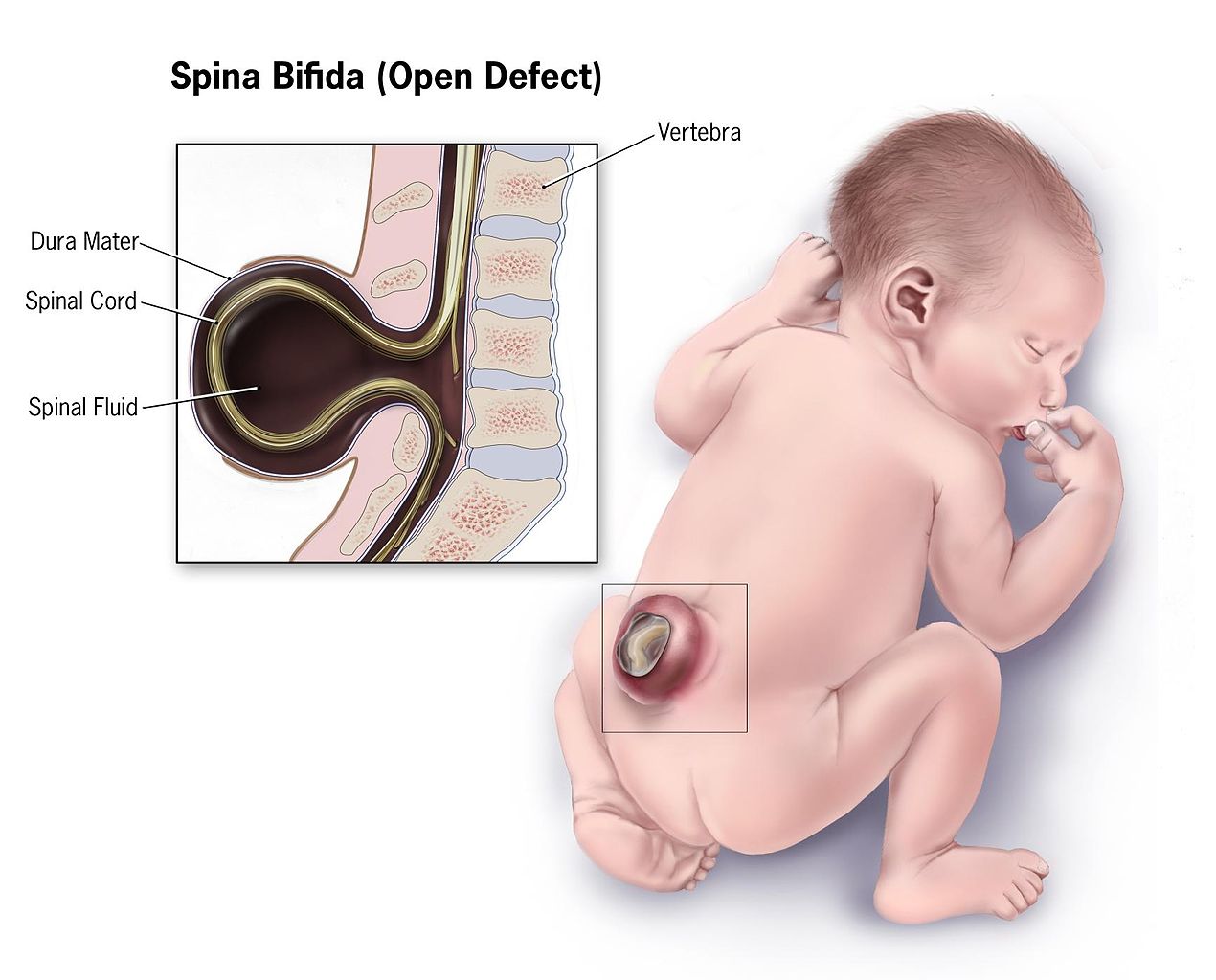 <p>Infant With Spina Bifida. This illustration depicts the characteristics of an infant with spina bifida.</p>