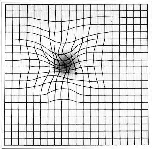 Amsler Grid, Age-Related Macular Degeneration.