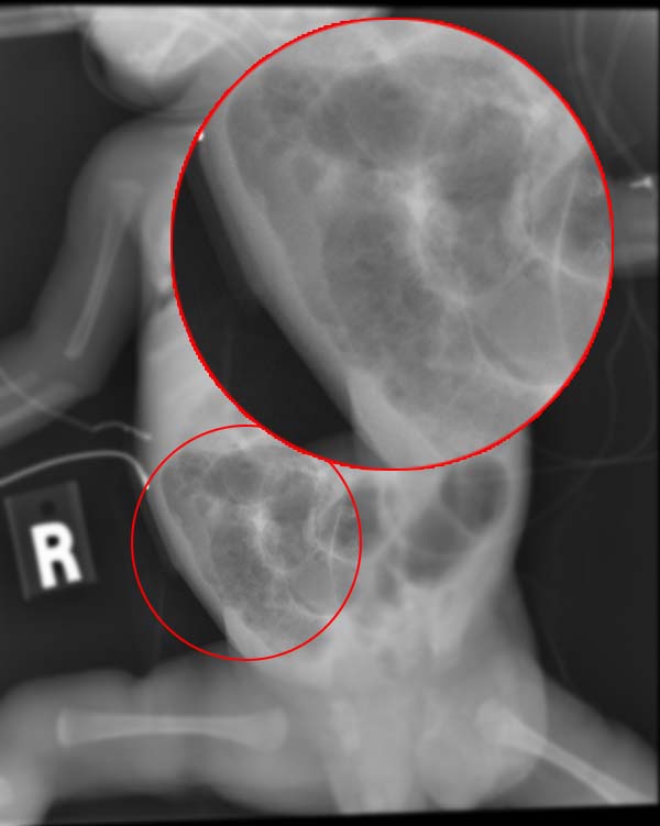 Radiograph of an infant with necrotizing enterocolitis