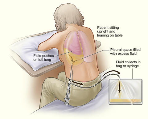 <p>Thoracentesis