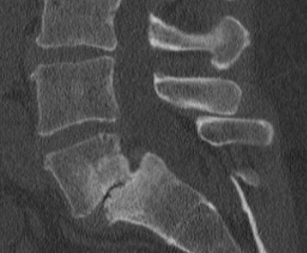 Sagittal CT of Lumbar Spine of L5-S1 Grade II Spondylolisthesis